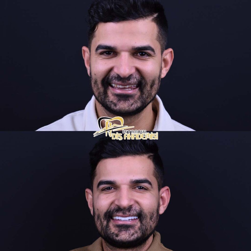 Hastamızın tedavi öncesi ve sonrası.